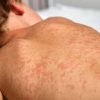 Update on Measles in Manitoba – Awareness and Prevention